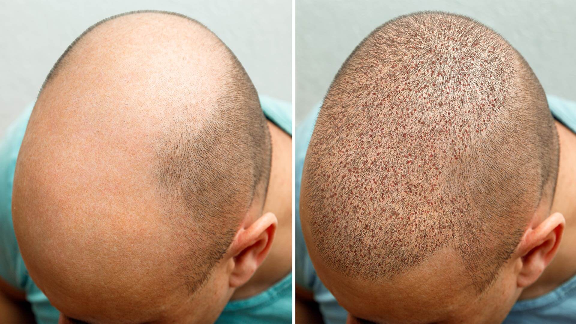 Factors to Consider When Getting a Hair Transplant